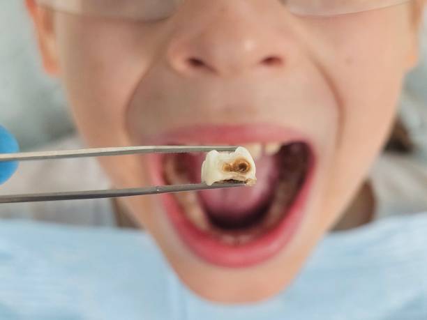 Best Emergency Root Canal Treatment in South Houston, TX