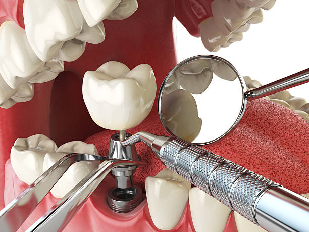 Best Emergency Tooth Extraction in South Houston, TX